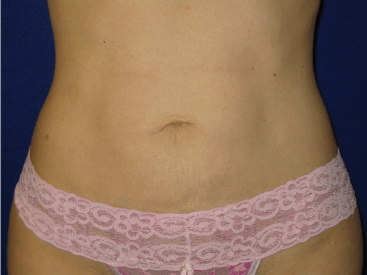 , Liposuction Before and After Pictures in Tampa, FL