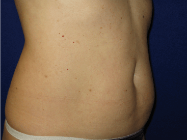 , Liposuction Before and After Pictures in Tampa, FL