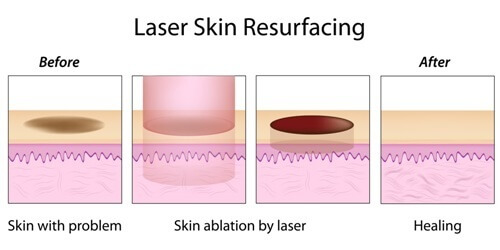 laser skin resurfacing tampa, Laser Skin Resurfacing in Tampa, FL