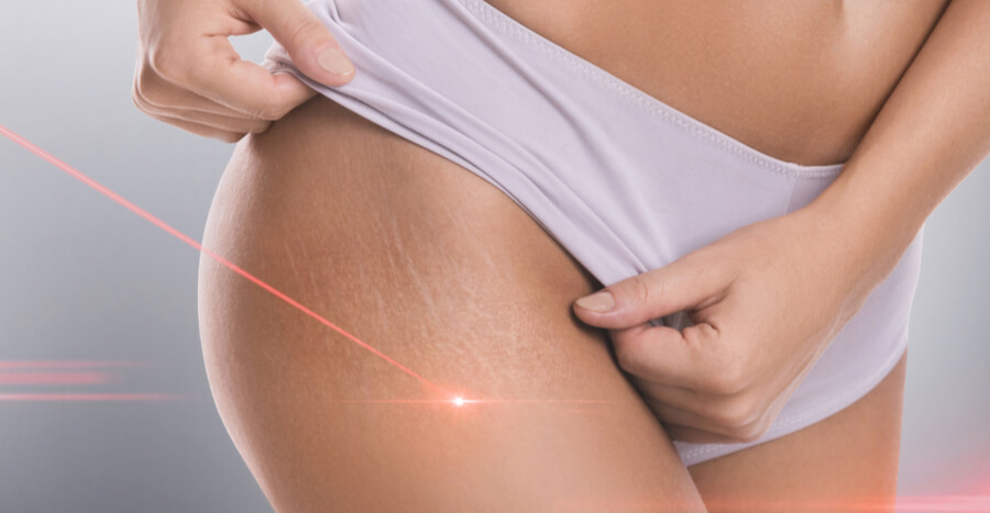 stretch mark removal treatment, Stretch Mark Removal in Tampa, FL