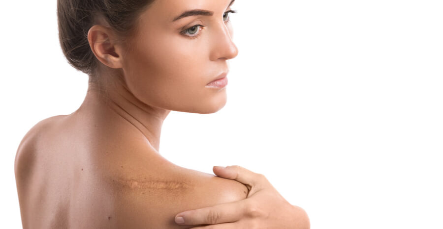 scar reduction, Scar Reduction in Tampa, FL