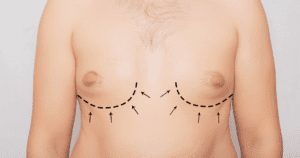 breast augmentation fl