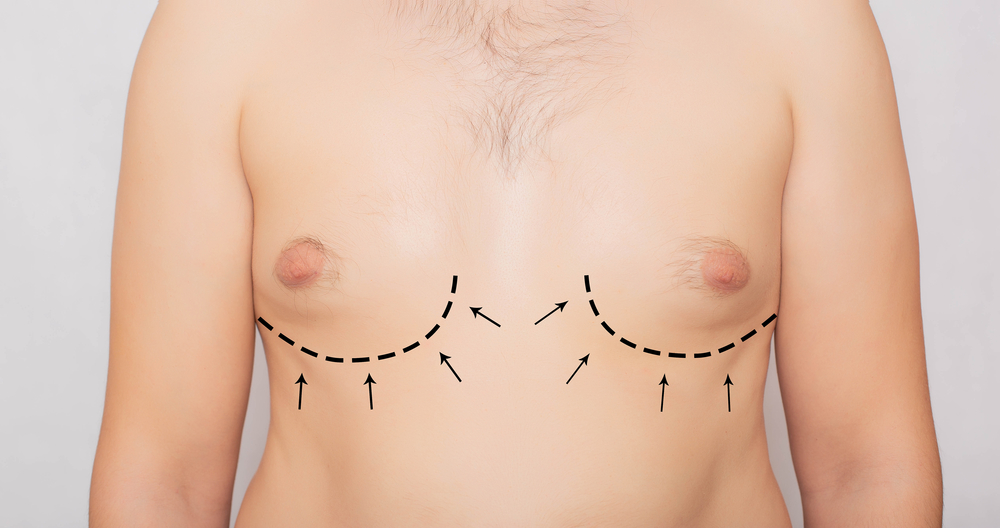 Breast Augmentation gynecomastia 6