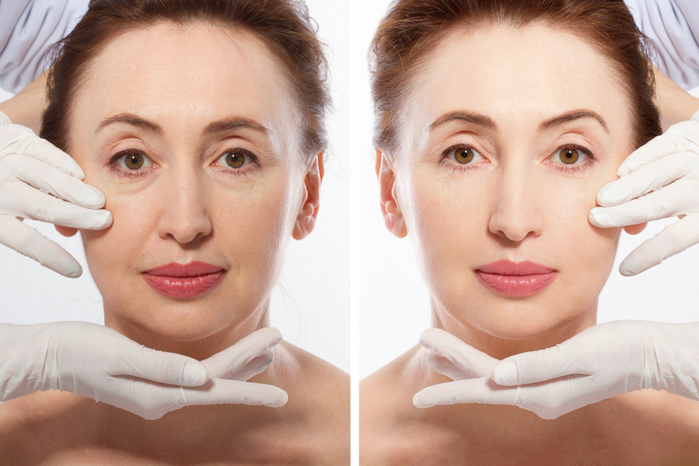 How to Prepare for Your Facelift Surgery A Step by Step Guide | Soler Cosmetic Plastic Surgery