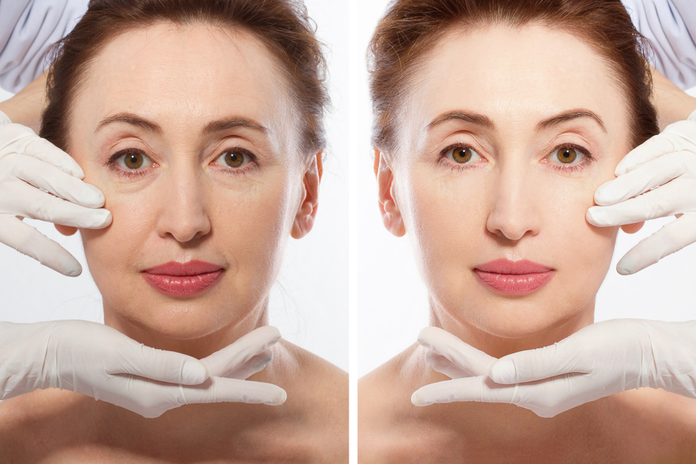 The Ultimate Guide to Facelift Surgery What to Expect and How to Prepare | Soler Cosmetic Plastic Surgery