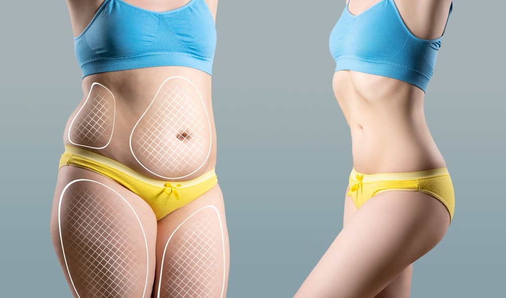 Tummy Tuck vs. Liposuction Which One Is Right for You | Soler Cosmetic Plastic Surgery