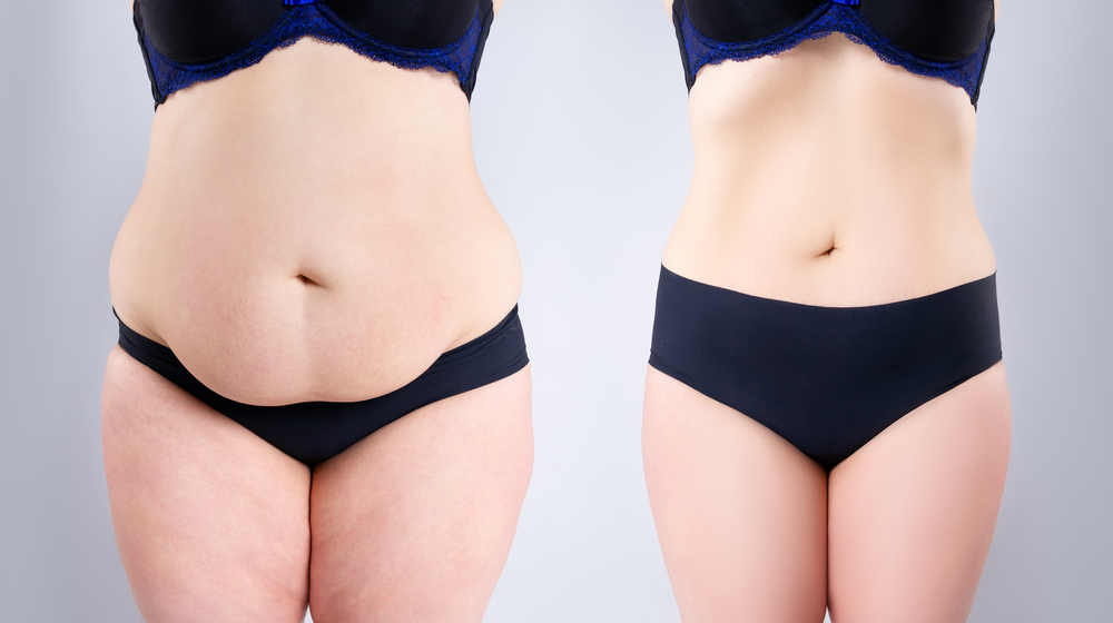 Unlock Your Ideal Body The Ultimate Guide to Liposuction | Soler Cosmetic Plastic Surgery