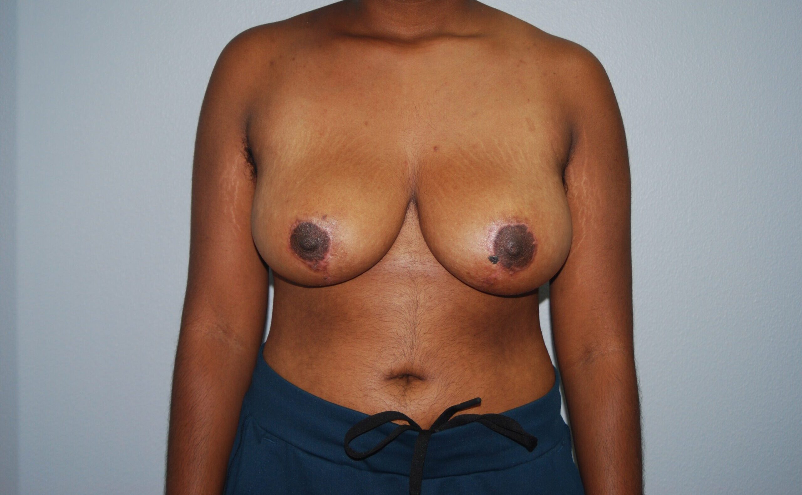 after breast reduction side view