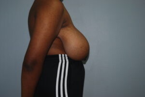 Before Breast Reduction side view 