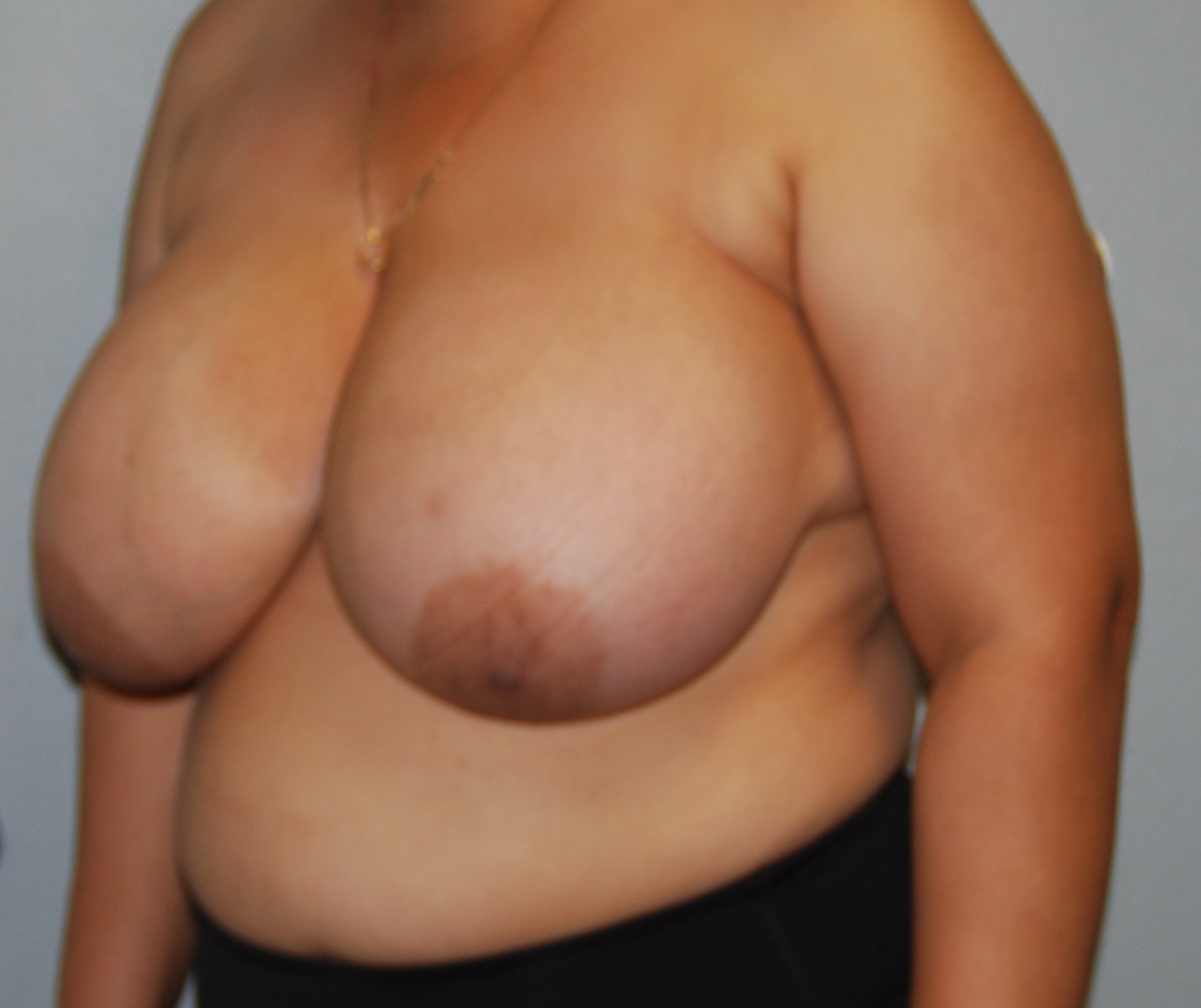 Antes de la reducción mamaria vista lateral 